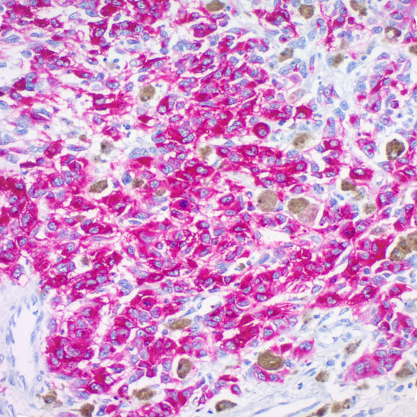 Melanoma (Clone HMB45 ) - Teomics