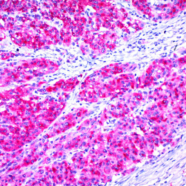 Melanoma, Pan Cocktail - Teomics