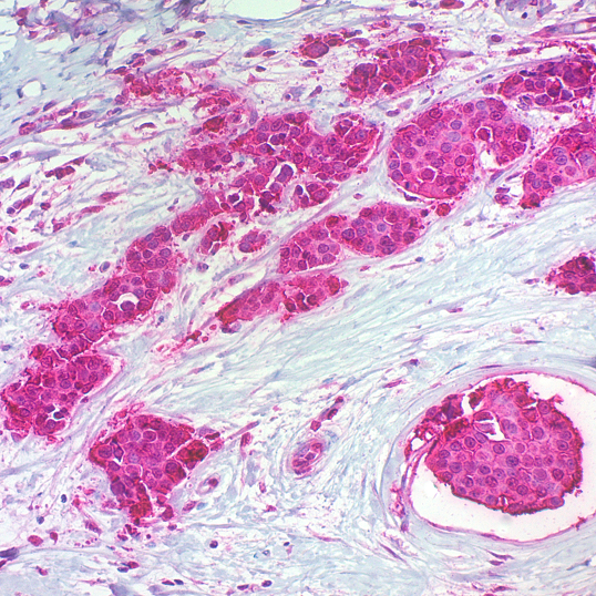 c-erbB-2 Oncoprotein - Teomics