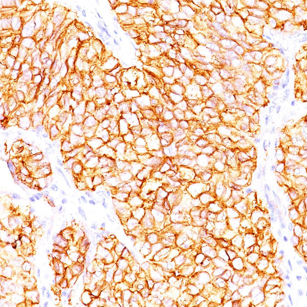 Renal Cell Carcinoma / gp200 (Clone 66.4.C2 & PN-15) - Teomics