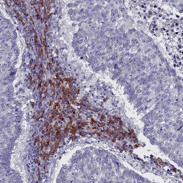 c-erbB-2 Oncoprotein - Teomics